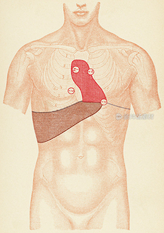 带听诊器和打击点的人体躯干的医学说明为一个病人的胸主动脉瘤，正面视图- 19世纪